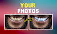 whiten, clean, and fix yellow teeth for stunning photos