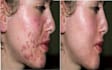 remove acne from up to 5 photos