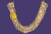 design dental crowns and bridges using exocad