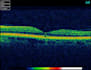interpret your OCT scans