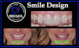design   smile design, mockup, snap on smile  with exocad