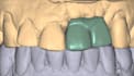 design your dental restorations