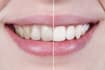 tell you how to get white teeth safely