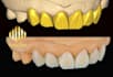 design dental crowns and bridges for digital dentistry
