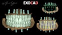 screw retained prosthesis crowns, bridges, full arch