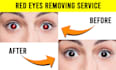 remove red eye, red eye removal within 30 minutes