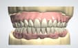do denture design using 3shape