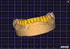 design anatomical mono, cutback and implant teeths