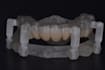 design implant surgical guide and stackable guide in realguide