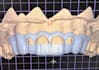 design gingivectomy and bone reduction guide in one in exocad