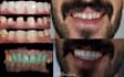 make dental designs on exocad crown x bridge  x implant bar