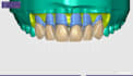 design new smiles in exocad