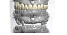 3shape exocad crown and bridge so cheap