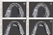 high quality dental 3d file meshing with meshmixer