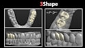 design crown, bridge, and wax up using 3shape software