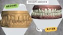 your design clear aligner orthodontic case with 3shape ortho