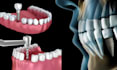 3d surgical dental medical animation anatomy animation 3d teeth surgery video