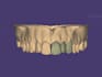 design crowns and bridges