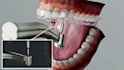 create 3d dental implant animation orthodontic explainer and dental device video