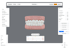 custom aligner treatment plans with 3d clincheck