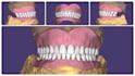design custom trays, bite registration and denture on exocad