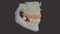 create a 3d biomodel printable  for surgical plans
