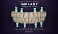design dental crowns bridges and implants in exocad