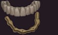 dental design for hybridbridge