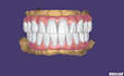 design smile, veneers, crown, bridge, implants using exocad