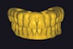 design full arches over implants on exocad