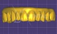 design crowns and bridges in exocad