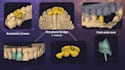 design crowns, bridges, onlays, maryland etc in exocad
