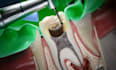 medical animation anatomy surgery biomedical animation medical oral implants vid