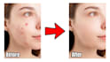 retouch your skin, remove your pimples in photoshop