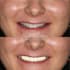 design precise dental cad models using exocad