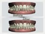 design best clear aligners treatment planning