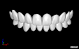 exocad design esthetic veneers, crowns, implants