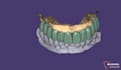 create a high quality digital smile design in exocad first crown free