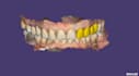 do dental design using exocad software based on your scans