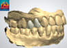 3shape design for crowns, implants, bridges, inlaysonlays, etc