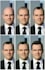 show your realistic hair transplant before and after result