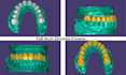 create high quality dental restorations using exocad