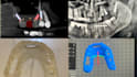 do implant planning, surgical guides, and stackable guides