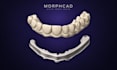 design custom dental implant bars and ibars in exocad