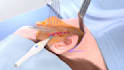 create realistic and cgi 3d medical animation for surgery procedures