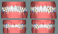 do clear aligners treatment planning on onyxceph, softsmile