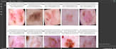 build a CNN model to detect skin diseases from images