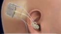 create 3d medical animation medical explainer ear surgical procedure animation