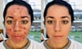 remove professionally acne or retouching only 10 mint