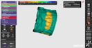 create accurate dental prosthesis designs using exocad